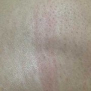 孕期屁股变黑（屁股下皮肤发黑怎么回事呢）
