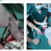 胎儿死在腹中怎么处理（胎儿死在腹中需要手术吗）