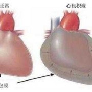 胎儿心包腔积液（胎儿心包腔积液是怎么导致的）