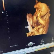 四维彩超胎儿左心室强光点（四维彩超胎儿左心室强光点怎么办）