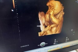 四维彩超胎儿左心室强光点（四维彩超胎儿左心室强光点怎么办）