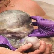 36周剖腹产胎儿的影响（36周剖腹产胎儿的影响）
