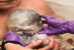 36周剖腹产胎儿的影响（36周剖腹产胎儿的影响）