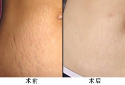孕期4个月长了妊娠纹怎么办,孕期长妊娠纹了怎么办呢