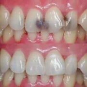 怀孕期补牙（怀孕期补牙影响胎儿吗）