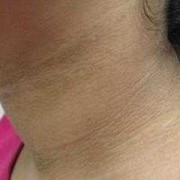 孕期脖子黑怎么回事（孕妇脖子和腋下变黑是怎么回事）