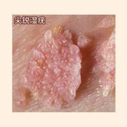 孕期肛门长肉疙瘩（孕期肛门长肉疙瘩会自己恢复吗）