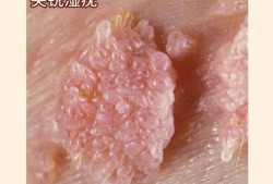 孕期肛门长肉疙瘩（孕期肛门长肉疙瘩会自己恢复吗）