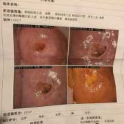 孕期宫颈活检（孕期宫颈活检有危险吗）