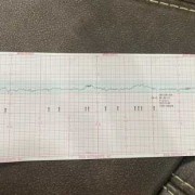 胎心监护是指什么,胎儿胎监心率多少是正常的