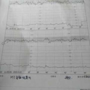 胎心监护基线偏低怎么回事,胎儿胎心偏低怎么办