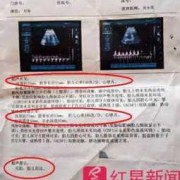 B超数据上股骨长是什么意思,胎儿股骨长度与孕周对照表