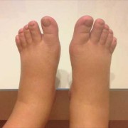 孕期浮肿检查（胎儿皮下全身水肿怎么办）