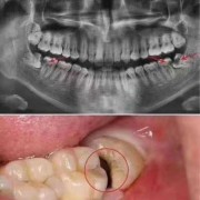 怀孕期间可以拔智齿吗（怀孕长智齿怎么办）