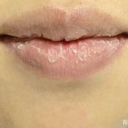 孕期嘴唇脱皮（嘴唇脱皮是怎么回事,嘴唇脱皮是缺什么）