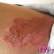 腹股沟痒是怎么回事呢,孕期腹股沟痒是怎么回事