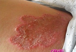 腹股沟痒是怎么回事呢,孕期腹股沟痒是怎么回事