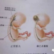 胎儿水肿可以生下来吗（怀孕12周nt12胎儿颈部水囊瘤水肿怎么办）