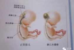 胎儿水肿可以生下来吗（怀孕12周nt12胎儿颈部水囊瘤水肿怎么办）