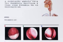 怀孕期间扁桃体发炎怎么办（怀孕七个月，嗓子发炎，晚上睡不着怎么办）
