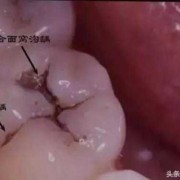 孕期牙破了（孕期牙破了个洞神经疼怎么办）