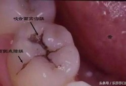 孕期牙破了（孕期牙破了个洞神经疼怎么办）