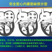 胎儿发育有的心脏为什么会发育不好,胎儿心内膜垫缺损原因有哪些