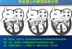 胎儿发育有的心脏为什么会发育不好,胎儿心内膜垫缺损原因有哪些