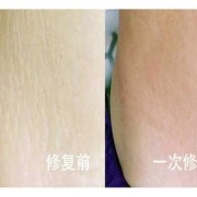 怀孕期间妊娠纹怎样能消除（怀孕期间妊娠纹怎样能消除掉）