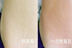 怀孕期间妊娠纹怎样能消除（怀孕期间妊娠纹怎样能消除掉）