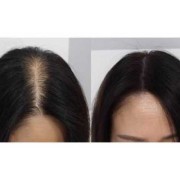 头发脱发怎么办,怀孕期脱发严重怎么办