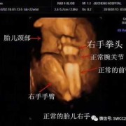骨折都有哪些表现,胎儿骨折有什么症状表现