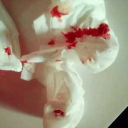 孕期鼻子出血（孕期鼻子出血怎么回事正常吗）