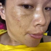 孕期皮肤变黑（怀孕后乳房变黑怎么回事）