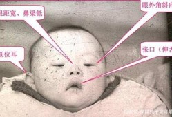 怀唐氏儿的孕妈妈有什么症状呀,唐氏儿孕妇孕期症状