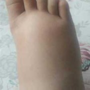 怀孕为什么脚会肿，怀孕脚肿怎么办,孕期肿脚肿腿的原因是什么
