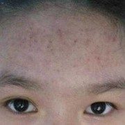 孕期爆痘（孕期爆痘是男孩还是女孩）