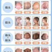 脑袋扁怎么变圆,胎儿头扁属于畸形吗图片