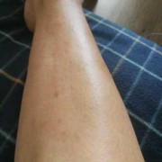 孕晚期，小腿痒怎么办,孕期小腿瘙痒怎么回事