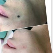 孕期能去痣吗（孕期能去痣吗有影响吗）