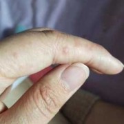 孕期手长湿疹怎么办（孕妇长湿疹怎么办）