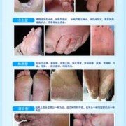 怀孕期间烂脚丫怎么办（怀孕期间烂脚丫怎么办啊）