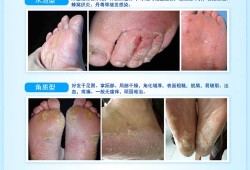 怀孕期间烂脚丫怎么办（怀孕期间烂脚丫怎么办啊）