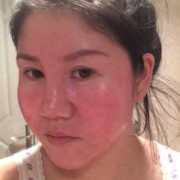 孕期脸变胖（孕妇脸和手也肿了，怎么办）