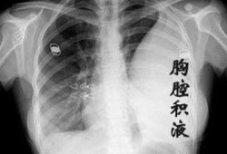 胎儿胸腔积水生下来了（胎儿胸腔积水生下来了）