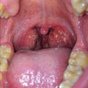 孕妇八个月扁桃体发炎引起的咳嗽怎么办,孕期扁桃体发炎肿痛怎么办