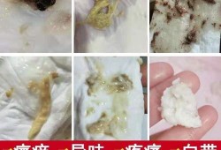 孕期白带腥味（白带有腥臭味是什么原因？该用什么药）