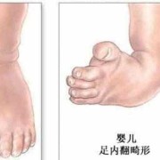 胎儿足内翻怎么回事,胎儿足周是多少周