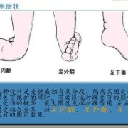 胎儿足内翻（胎儿足内翻是什么原因导致的）
