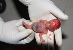 未成形的胎儿（未成形的胎儿算生命吗）